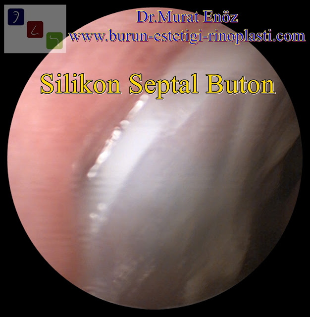 Silikon septal buton - Nazal septal buton - Septal buton uygulaması