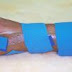 Hand Orthoses dan fungsi dari ortosis extermitas upper