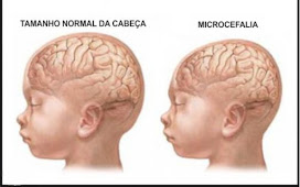 Microcefalia: 1.749 casos confirmados no Brasil