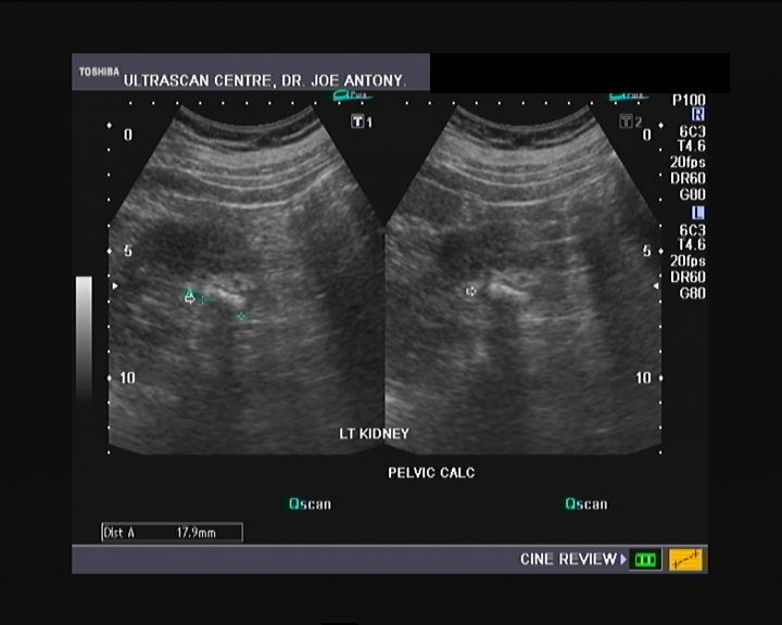 Cochinblogs: Kidney stones- renal calculi- urinary stones