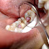 VIDEO: Tips para Pacientes con Caries Profunda