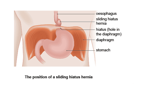 Hiatus Hernia: MMA Practicing People that have Hiatus Hernia Signs and 