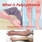 What is Polycythemia