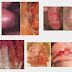 Buah Buahan Obat Penyakit Sipilis Paling Mujarab thumbnail
