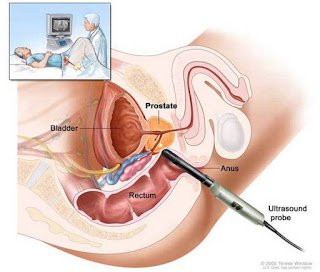 How to Deal with Prostate Cancer?