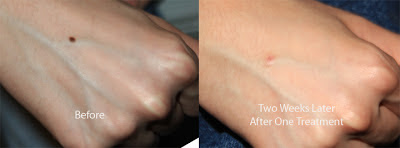 Mole Removal Scars