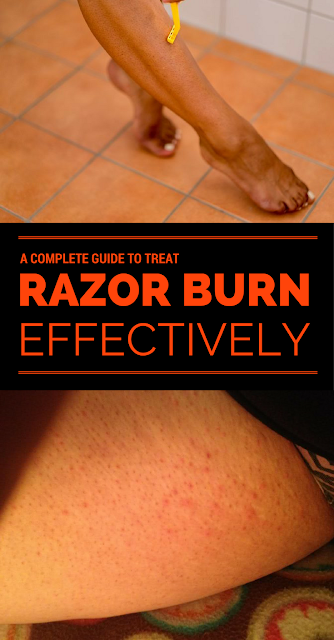 A Complete Guide To Treat Razor Burn Effectively