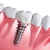 5 điều cần biết về cấy ghép răng implant