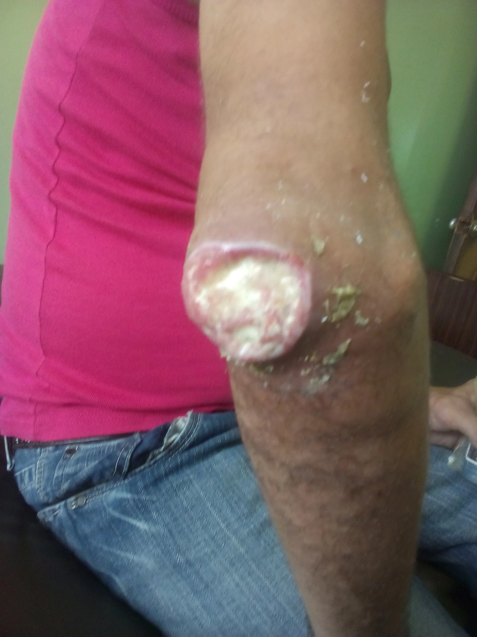 absceso en codo