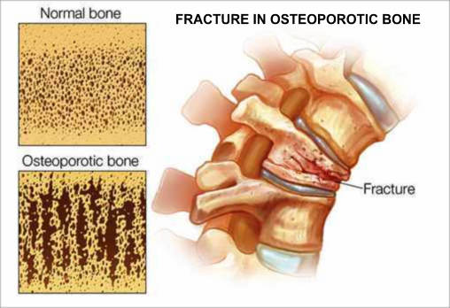 Osteoporosis Bone