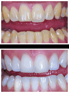 BEST TEETH WHITENING PRODUCTS | Best Teeth Whiteners Reviews 2013 