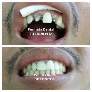 gambar foto contoh veneer gigi kelinci buatan manis cantik bali jember banyuwangi murah berkualitas di PERMATA DENTAL gambar gigi rusak yang di veneer gigi yang tidak rapi gigi renggang gigi patah cuil rompal pendek karies hitam kuning