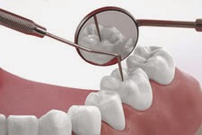 http://www.dental-clinic-delhi.com/dental-fillings.html