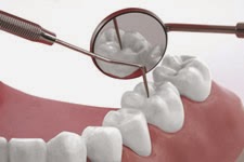 Tooth Filling Procedure and Cost Information - Dr. Garg's Dental Hospital‎