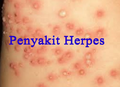 Cara Mengobati Penyakit Herpes Pada Mulut