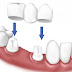 Trồng răng khi bị mất một răng bằng cấy ghép implant