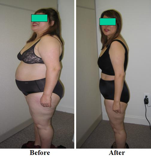 Fat Binders Weight Loss : Different Medigap Plans