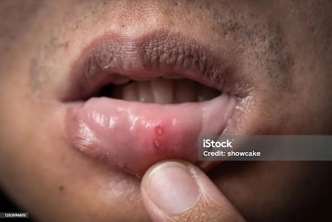 Canker Sores : causes, symptoms and treatments : How to Heal
