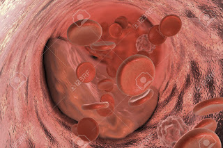   placa de ateroma, placa de ateroma formacion, ateroma calcificado, ateroma tratamiento, proceso de formacion de ateroma, como eliminar placas de ateroma, ateroma calcificado en aorta, sintomas de ateroma, ateroma aortico