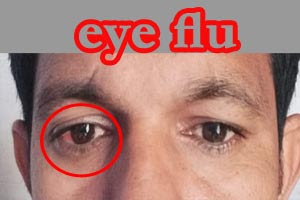 Increasing outbreak of eye flu in India