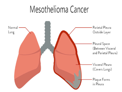 mesothelioma cancer what is it