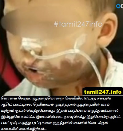 
Kulandhai valarppu murai | Child suffered sever injury after drinking Sulfuric acid 