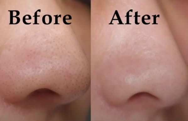 Cần sử dụng sản phẩm trị mụn đầu đen phù hợp với làn da để đạt hiệu quả