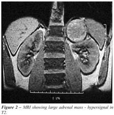 MRI-of-adrenal-gland-tumor-image-reload