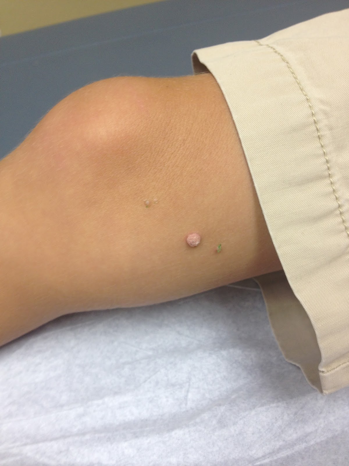 One of his knee warts before treatment. The green spots are the little 