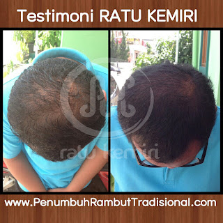 jual obat penumbuh rambut botak herbal ratu kemiri di palu 087823381610