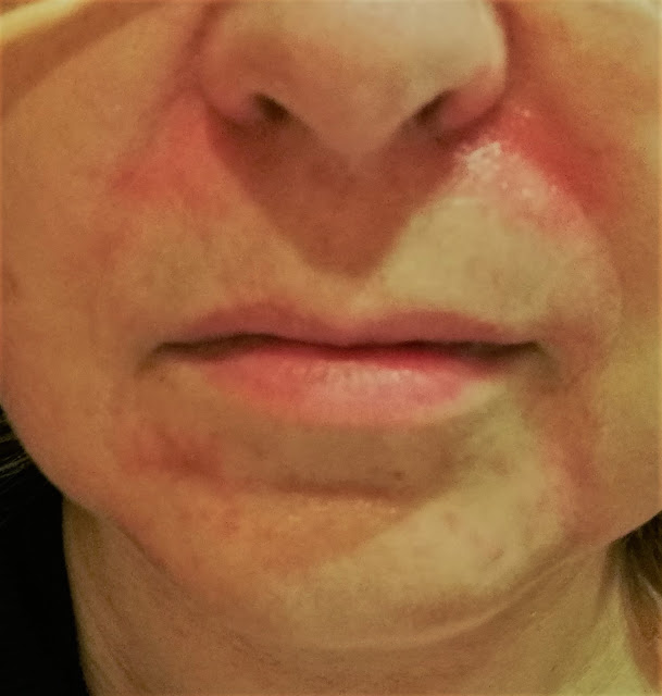 brote de dermatitis seborreica en la cara  Cuidarse a los 50