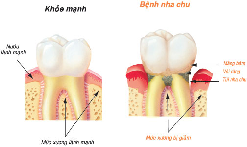 Nhổ răng khôn có ảnh hưởng gì sức khỏe thần kinh không ?