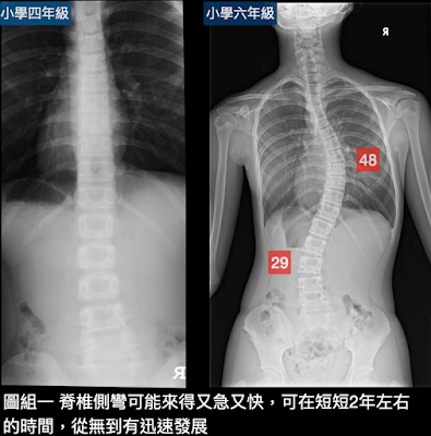 脊椎側彎惡化手術,脊椎側彎, 脊椎側彎治療