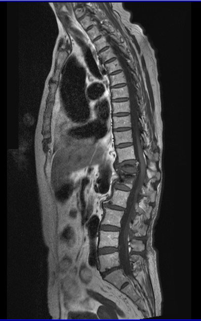 Plain Mri Of The Thoracic And Lumbar Spine Junction Radtechonduty