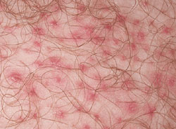 folliculitis