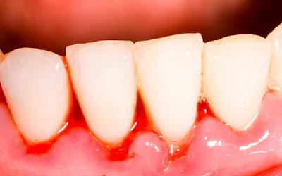 Nguyên nhân gây viêm lợi chân răng