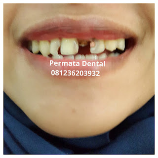 gambar foto contoh sebelum dan sesudah veneer gigi kelinci buatan manis cantik bali jember banyuwangi murah berkualitas di PERMATA DENTAL gambar gigi rusak yang di veneer gigi yang tidak rapi gigi renggang gigi patah cuil rompal pendek karies hitam kuning