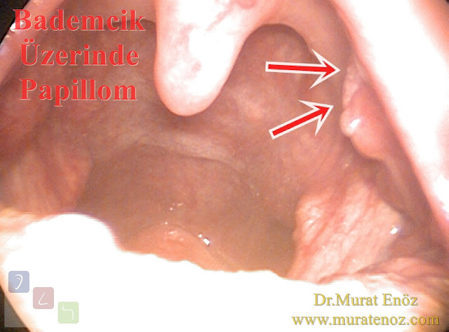 Bademcik papillomu - Bademcik üzerinde siğil - Boğazda siğil - Ağızda HPV enfeksiyonu - Bademcik papillomu foto