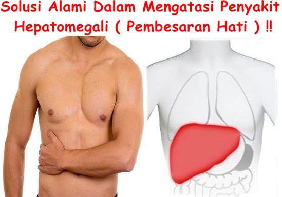 Obat Tradisional Hepatomegali ( Pembesaran Hati )