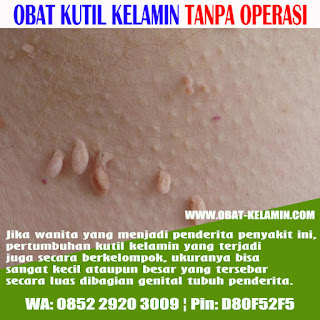 Obat Kutil Kelamin, Mengobati Kutil Kelamin, Mengatasi Kutil Kelamin, Menyembuhkan Kutil Kelamin, Menghilangkan Kutil Kelamin, Penghilang Kutil Kelamin, Penghapus Kutil Kelamin, Perontok Kutil Kelamin, Cara & Tips Menghilangkan Kutil Kelamin 1 Malam Langsung Coplok Rontok Hilang, Menghilangkan Kutil Kelamin Dari Rumah Sendiri Jangka 3 Hari, Obat Kutil Kelamin Manjur, Obat Kutil Kelamin Pria, Obat Kutil Kelamin Wanita, Obat Kutil Kelamin Laki-Laki, Obat Kutil Kelamin Perempuan, Obat Kutil Kelamin Ibu Hamil (Menyusui / Mengandung), Obat Kutil Kelamin Herbal, Obat Kutil Kelamin Mujarab, Obat Kutil Kelamin Alami, Obat Kutil Kelamin Di Apotek, Obat Kutil Di Kelamin, Dubur / Anus, Obat Kutil Di Paha, Obat Kutil Kelamin Di Apotik, Obat Kutil Di Dalam Kelamin / Luar Kemaluan, Ubat Ketuat Kelamin, Obat Tahi Lalat Kelamin, Obat Kutil Kondiloma, Krim Kutil, Obat Kutil Ampuh, Obat Kutil Kelamin Tanpa Operasi Terbukti Keampuhannya, Cream Kutil, Salep Untuk Kutil, Obat Oles Buat Kutil, Obat Penghilang Kutil Pada Kulit Kelamin Yang Terbukti Aman Tanpa Efek Samping Serta Terpercaya..