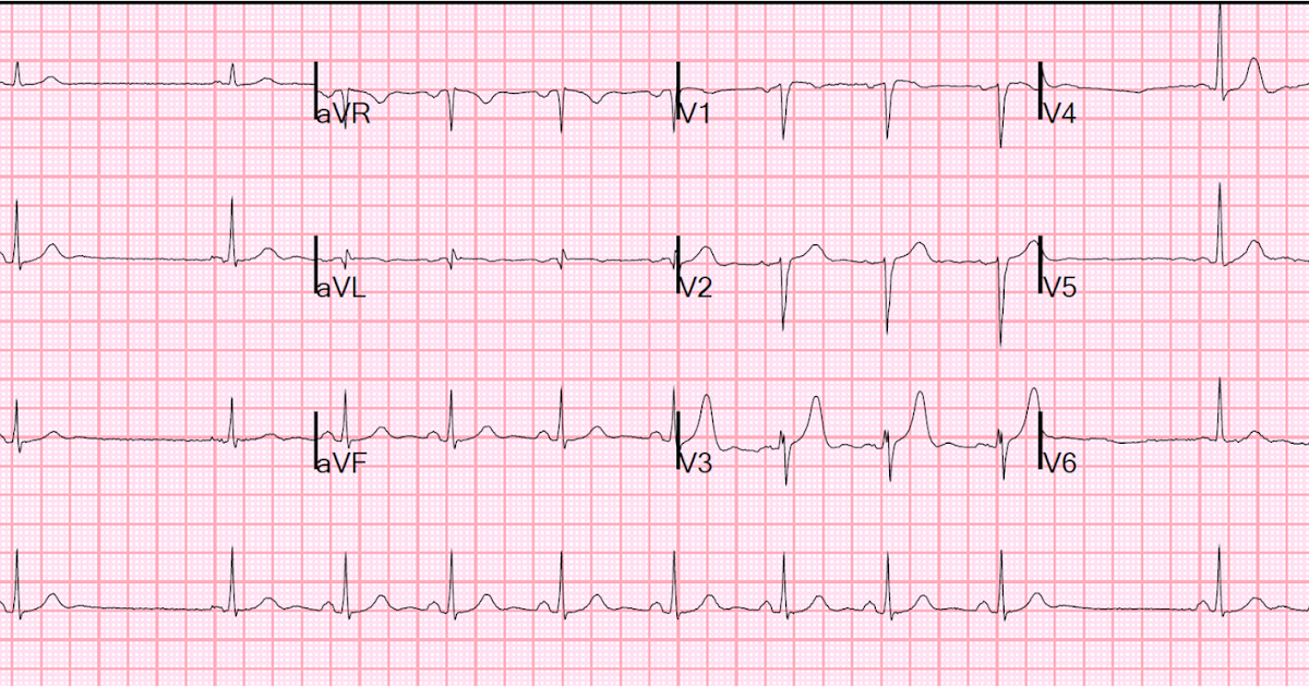 Dr Smith S Ecg Blog Two Interrupted Sinus Beats What Is The Etiology