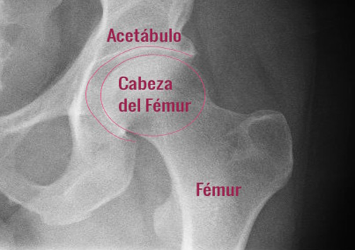 Displacia de cadera en bebes