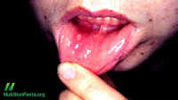 Frequent Mouth Ulcers
