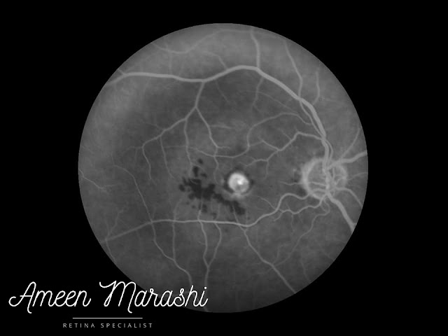Mid phase showing hyperfluorescence and leak from classical CNVm