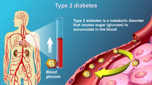 Type 2 Diabetes