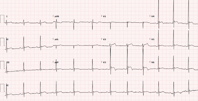 Understanding this pathognomonic ECG would have greatly benefitted the patient.