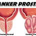 Cara Mengatasi Kanker Prostat