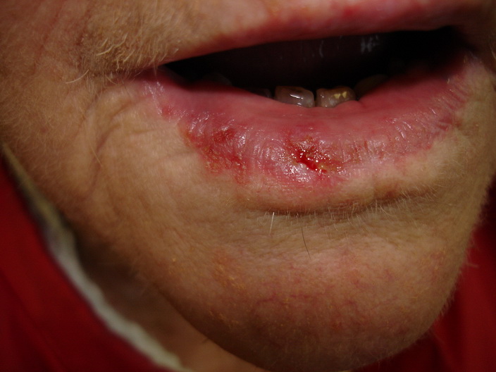 Scc lip