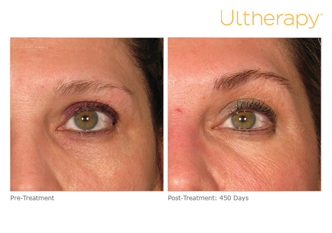 New Year New You ~ What Is Ultherapy? - Corinna B's World