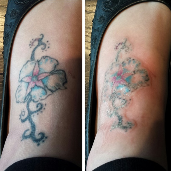 Top Tattoo Art: Laser Tattoo Removal After One Session